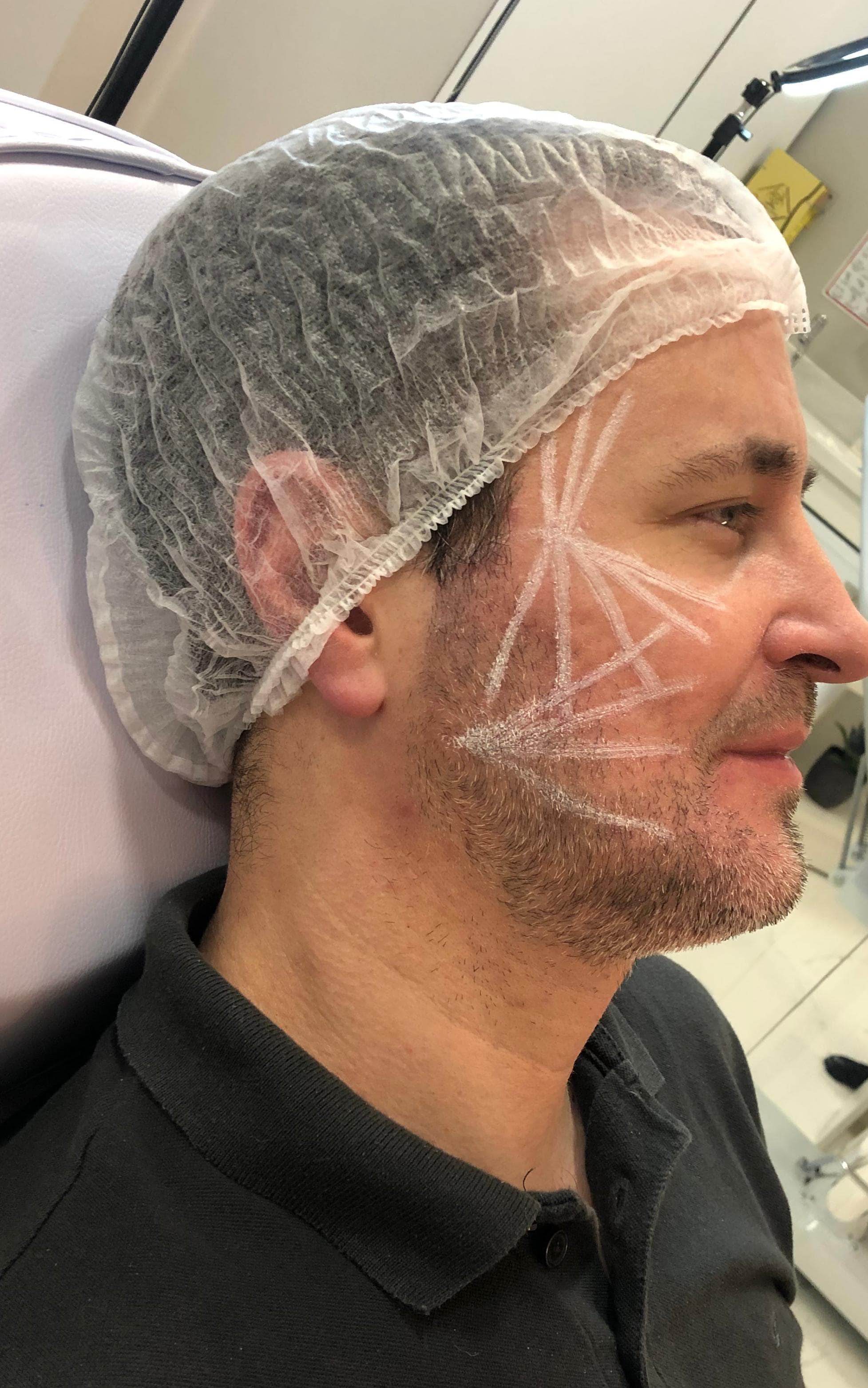 bioestimuladores de colágeno